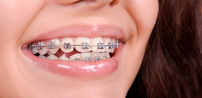 malocclusione