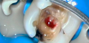 Caratteristiche della pulpite fibrosa cronica, sua diagnosi e trattamento