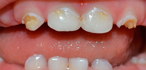 O que é importante saber sobre a cárie de dentes decíduos em crianças pequenas