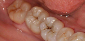 Como reconhecer a cárie dentária: métodos básicos de diagnóstico