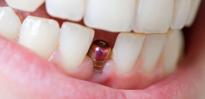 Quanto dura di solito un impianto dentale e quanto tempo può essere sostituito