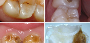 Como pode ser a cárie dentária: fotos