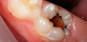 Classificazione della pulpite dal punto di vista di un dentista praticante