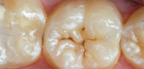 Como proteger os dentes da cárie: uma revisão de métodos eficazes
