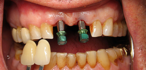 L'impianto dentale è possibile con parodontite e malattia parodontale?