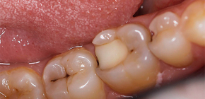 Rimedi popolari per un rapido sollievo dal mal di denti