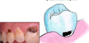 Tratamento de cárie cervical