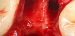 Come posso fermare il sangue dopo l'estrazione del dente