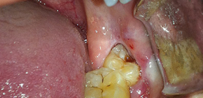 È necessario rimuovere i denti del giudizio o è meglio provare a trattarli?