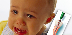 Trattamento della pulpite dei denti decidui nei bambini