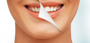 Qual clareamento dental é o mais seguro e suave para o esmalte?