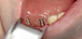 Tipi moderni di impianti dentali e prezzi standard per questa procedura