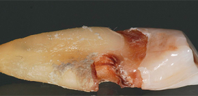 Características da cárie radicular e seu tratamento