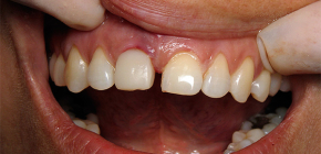 Sintomi di rigetto dell'impianto dentale: con quali segni è possibile riconoscere un problema?