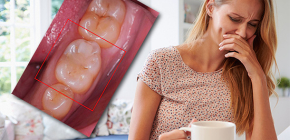 Cosa fare quando si verifica mal di denti durante la gravidanza