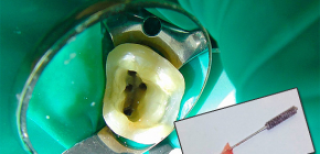 Cosa fare se il dente fa male dopo aver rimosso il nervo e aver pulito i canali