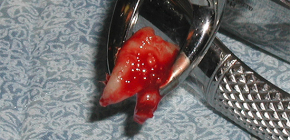 Particolari interessanti sull'estrazione mascellare dei denti del giudizio
