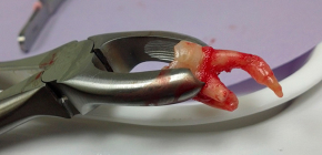 Quanto costa rimuovere un dente oggi: panoramica dei prezzi per diversi casi clinici