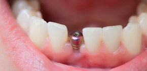 Cosa è incluso nell'impianto dentale chiavi in ​​mano e cosa dovrà essere pagato separatamente