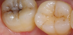 Sintomi caratteristici di pulpite purulenta acuta e metodi del suo trattamento
