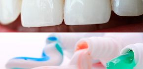 Como escolher creme dental de cárie: selecionamos a melhor opção