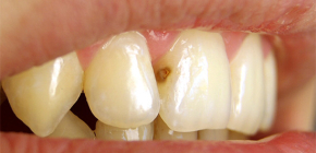 O que fazer se a cárie aparecer nos dentes da frente