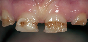 Sobre cárie negligenciada: o que fazer se houver sinais de cárie em quase todos os dentes