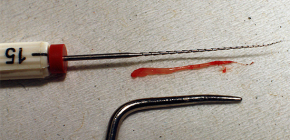 Come rimuovere un nervo da un dente e quali problemi possono sorgere