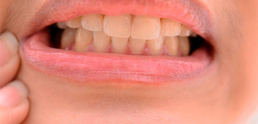 Cosa si può fare a casa per alleviare il mal di denti grave
