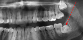 Trattenuto denti del giudizio e la loro rimozione (quando non possono esplodere)