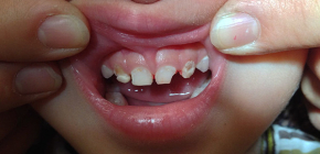Cosa fare se un bambino ha mal di denti: come anestetizzare?