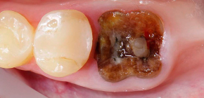 Rimozione delle radici del dente (quando la parte della corona viene distrutta o infiammazione alla radice)
