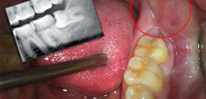 E se il dente del giudizio cresce e la gomma fa male?