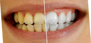 Como clarear os dentes em casa sem prejudicar o esmalte