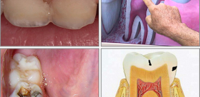 O que é cárie dentária?