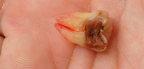Rimozione di un dente del giudizio situato sulla mascella inferiore