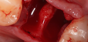 Per quanto tempo la gomma guarisce dopo la procedura di estrazione del dente ed è possibile accelerarne la guarigione