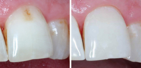 Existe um remédio ou cura eficaz para a cárie dentária?