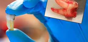 Quanto è doloroso rimuovere i denti del giudizio e quanto tempo fa la gomma fa male