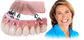 Tecnologias de próteses dentárias All-on-4 e All-on-6: semelhanças e diferenças