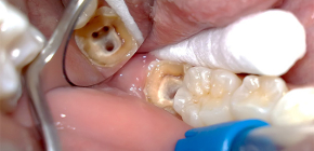 Che cos'è la polpite dentale: cause e potenziale pericolo