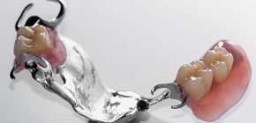Fecho de próteses dentárias e suas variedades