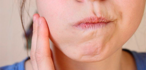 Come sciacquare un dente malato per alleviare rapidamente il dolore