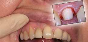 Cosa fare se un dente fa male sotto la corona
