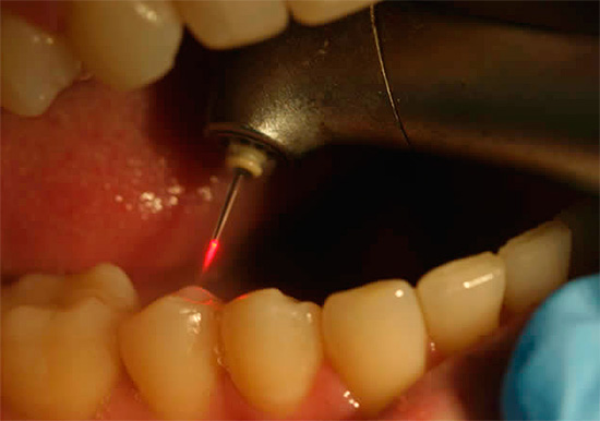 O uso de um laser no tratamento odontológico também pode reduzir significativamente a dor do procedimento.