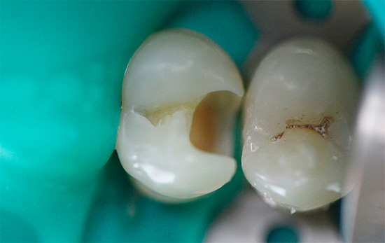 Nesses casos, o médico precisa remover a dentina infectada a uma profundidade considerável (um exemplo é mostrado na foto)
