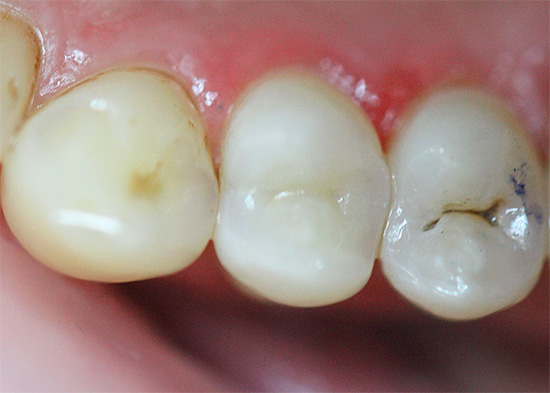 E parece um dente já preenchido após o tratamento