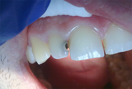 Aos primeiros sinais de danos nos dentes cariados, você precisa ir ao dentista, não espere até que uma cavidade profunda seja formada ...