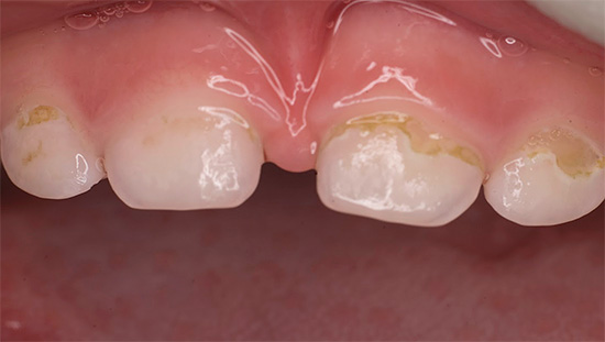 Una caratteristica della carie in bottiglia è la sconfitta simultanea di più denti contemporaneamente.