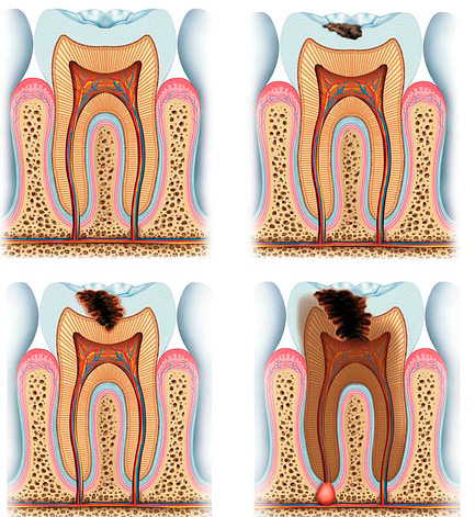 Il trattamento della carie profonda può essere complicato dalla vicinanza dei tessuti infetti alla camera pulpare del dente.